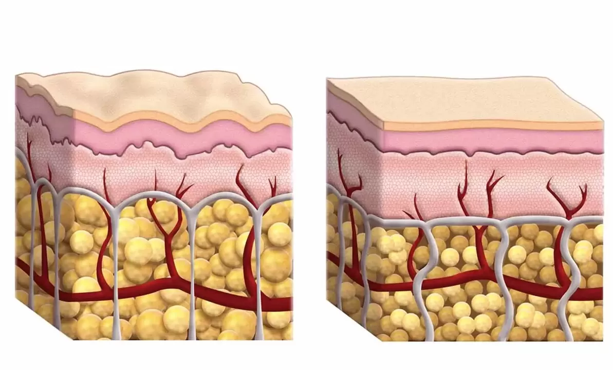 Cellules graisseuses pendant l'utilisation du gourou de Keto
